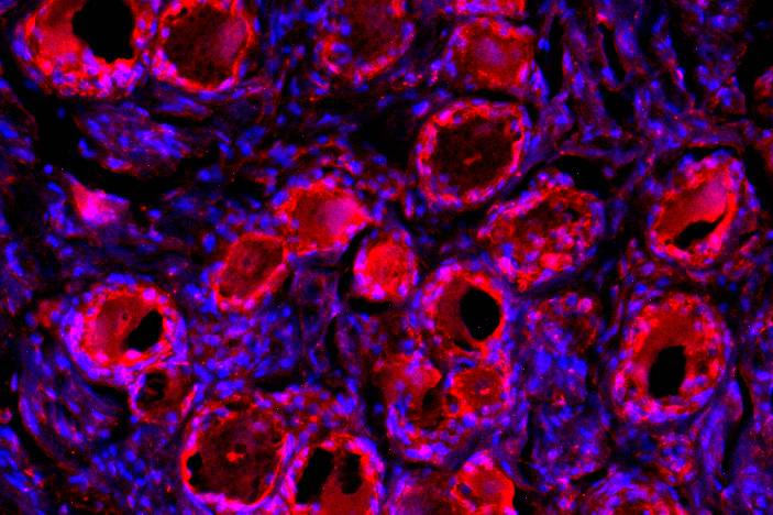Sensory neurons from human dorsal root ganglia, a collection of nerves and neurons near the top of the spinal cord, show red for PD-1, a binding site for immunotherapies against cancer. The blue stain shows cell nuclei. Photo credit: Ru-Rong Ji Lab, Duk