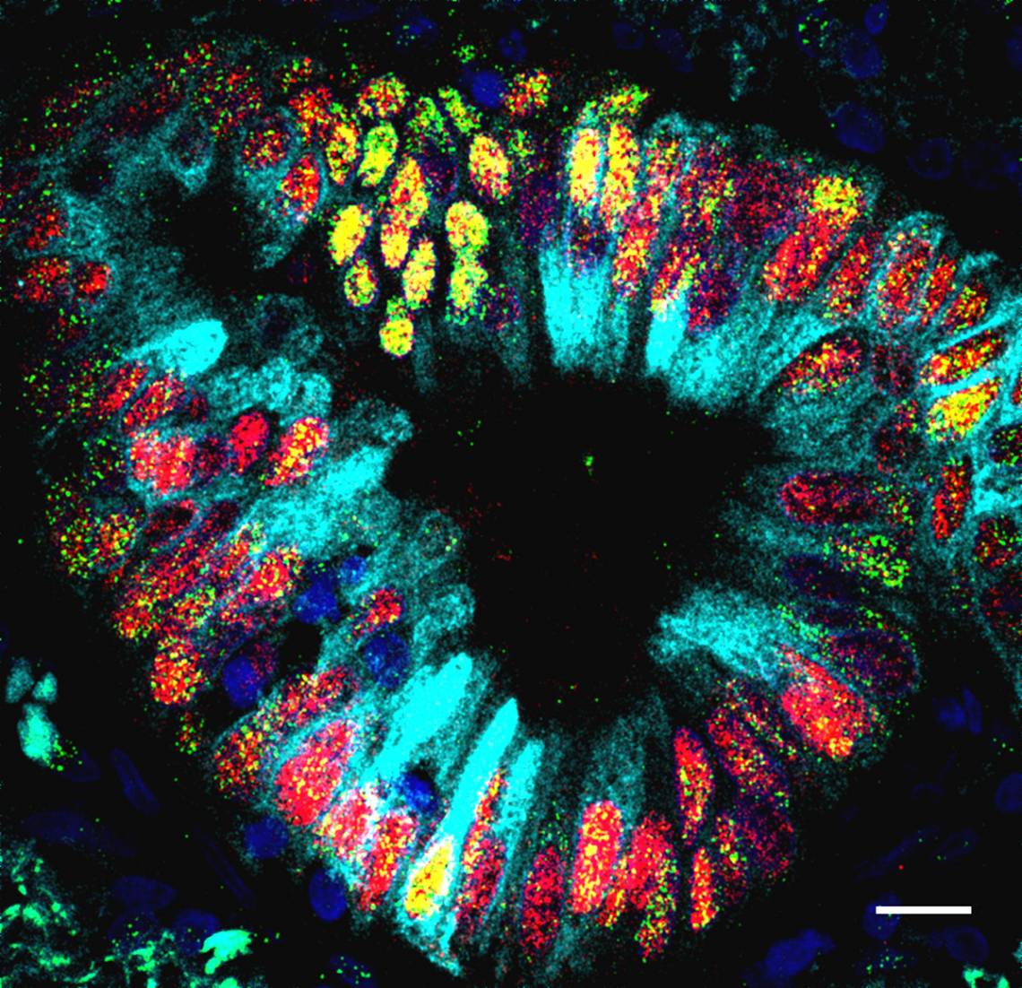 New research from Duke has found that some lung cancer cells with errors in transcription factors begin to resemble their nearest relatives – the cells of the stomach and gut. (Credit – Tata Lab, Duke University)