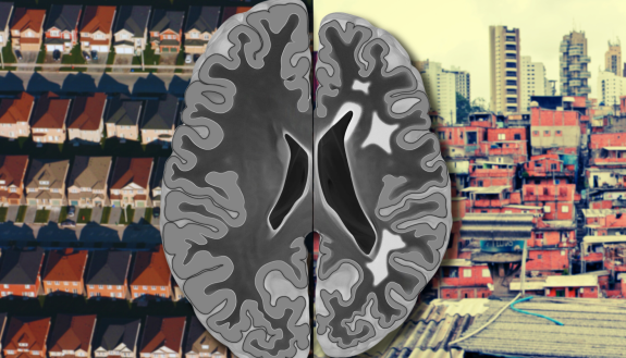 stylized brain scan, half typical adult, half reduced size for adult, overlaid suburb neighborhood aerial photo next to dense impecunious cityscape
