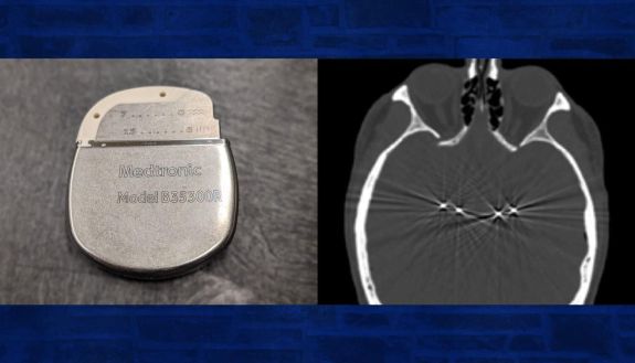 graphic showing brain stimulation therapy