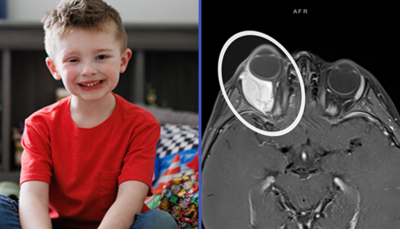 Colton Goodman at home, three years after diagnosis, image of his brain tumor