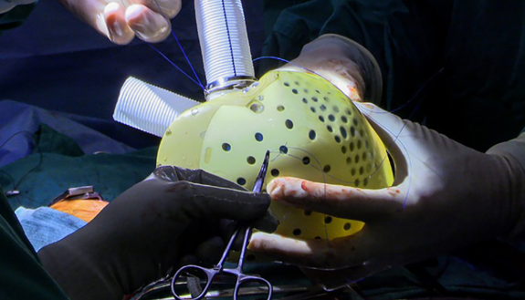 photo of the artificial heart implanted in a Duke heart patient