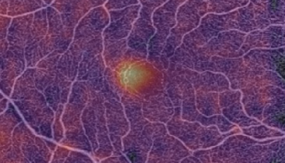 A form of artificial intelligence designed to interpret a combination of retinal images was able to successfully identify a group of patients who were known to have Alzheimer’s disease,