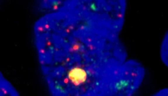 Some genetic mutations cause telemeres to remain long however, so cells never die, leading to immortal cells and tumor growth. 