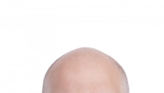 Hair loss