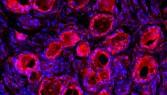 Sensory neurons from human dorsal root ganglia, a collection of nerves and neurons near the top of the spinal cord, show red for PD-1, a binding site for immunotherapies against cancer. The blue stain shows cell nuclei.   Photo credit: Ru-Rong Ji Lab, Duk