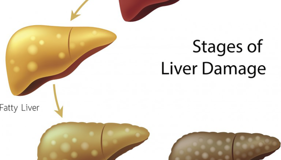 liver disease stages