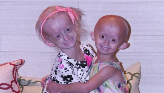 Progeria is a childhood disease with symptoms that resemble accelerated aging. Many affected patients die of heart disease brought on by weakened blood vessels before the age of 14. A single, random point mutation is responsible for the few hundred cases 