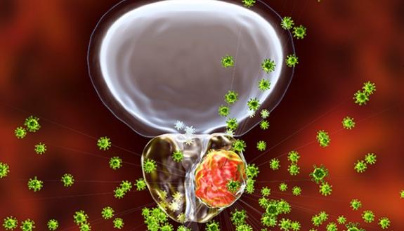 graphic drawing of a prostate cancer cell