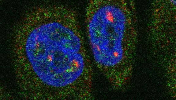 Individual RNA molecules fluoresce inside a breast cancer cell. Credit: Sunjong Kwon, Oregon Health & Science University
