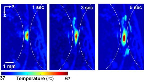 Photoacoustic imaging shows the absolute temperatures elevated by high-intensity focused ultrasound in small animal models at one, three and five seconds.