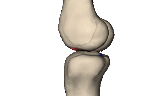 Duke scientists used MRI scans, computer algorithms and 3-D modeling to reconstruct how ACL tears occurred in 30 people. The motion causing ACL tears appears to be the same in men and women. (Louis DeFrate/Duke University)