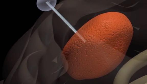 A biomedical tool that tricks aggressive brain tumors such as glioblastoma into migrating into an external container rather than throughout the brain has been designated a “Breakthrough Device” by the U.S. Food and Drug Administration (FDA).