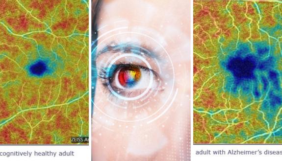 images of retinas of healthy individual and one with Alzheimer's